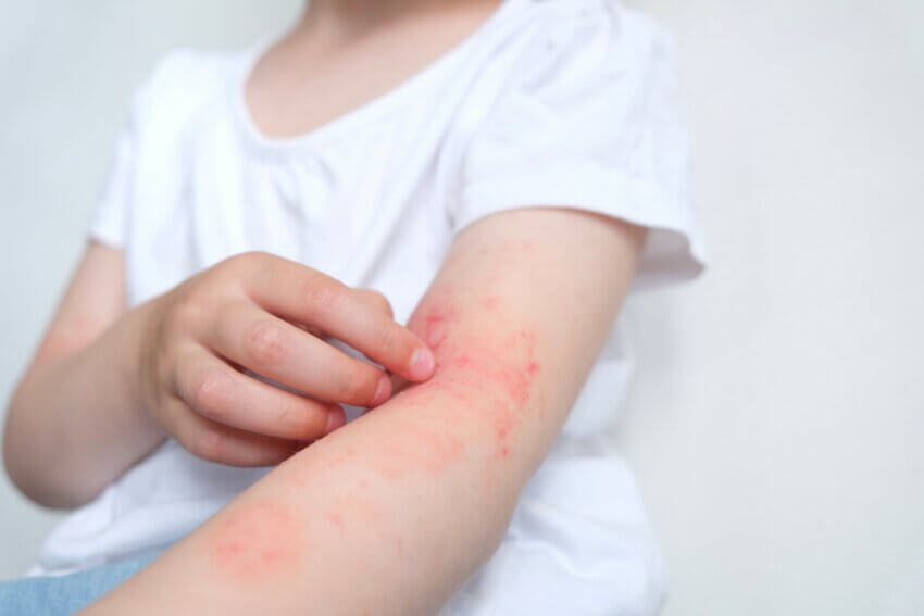 Allergie beim Kind mit Juckreiz