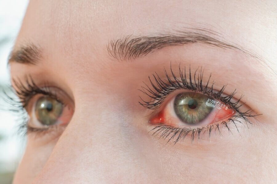 Rote Augen sind meistens harmlos