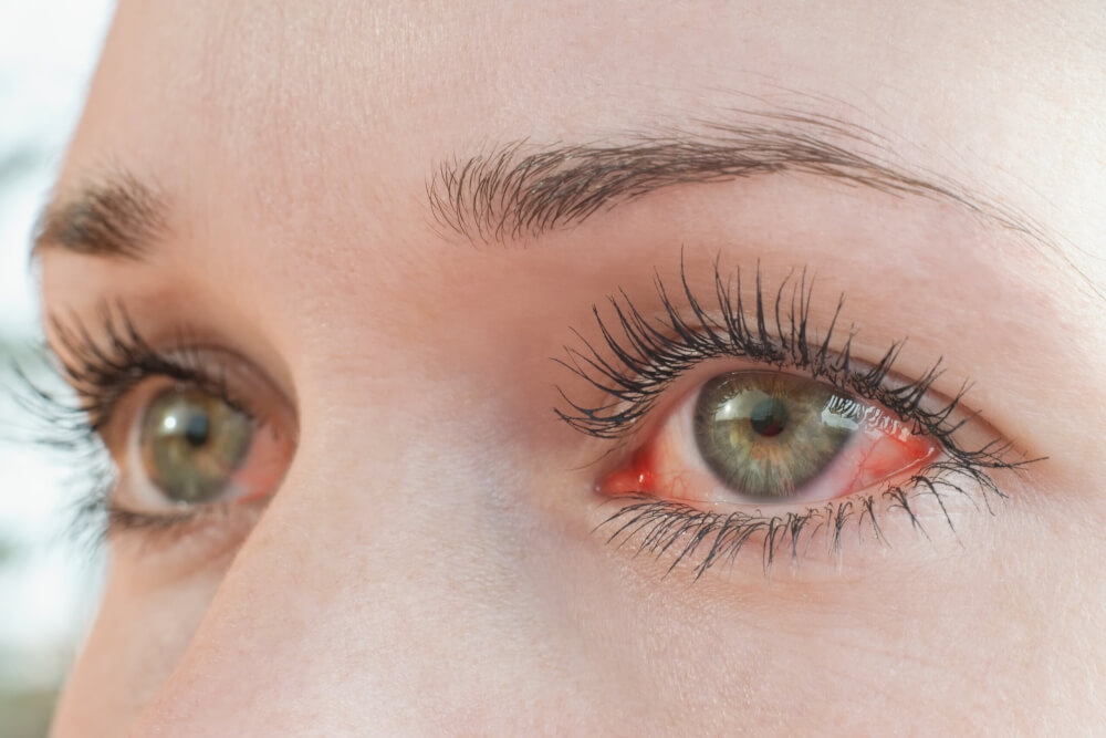 Rote Augen Was kann ich tun? apotheken welt