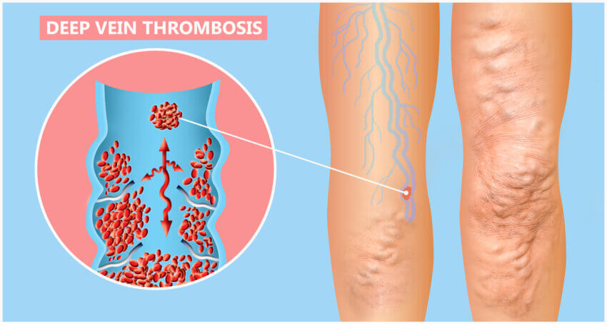 Thrombose ist eine gefährliche Venenerkrankung