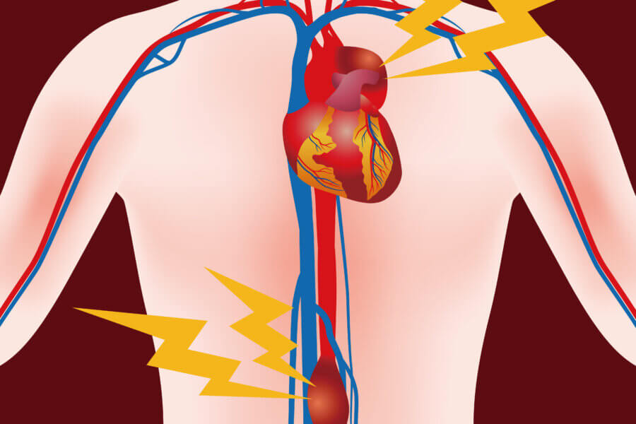 Hier ist ein Bauch- und Aortenaneurysma zu sehen
