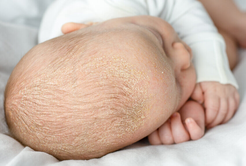 Bei Säuglingen betrifft es  oft die Kopfhaut