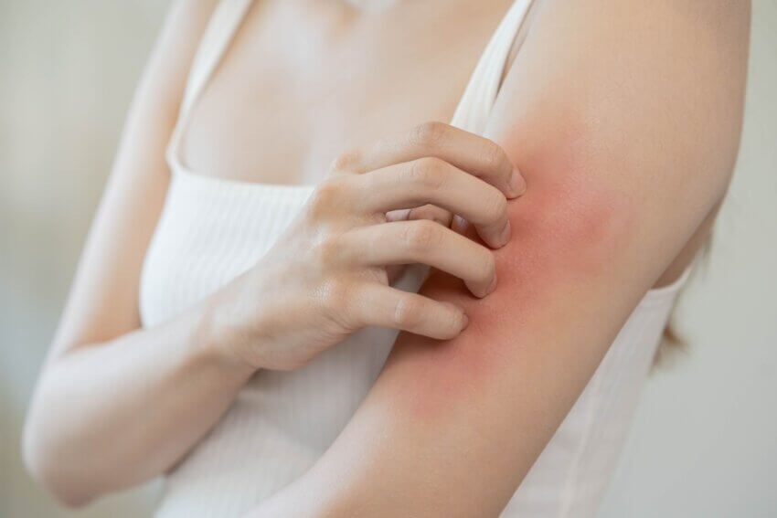 Nebenwirkung können sein, allergischen Reaktion können Hautausschläge, Juckreiz,