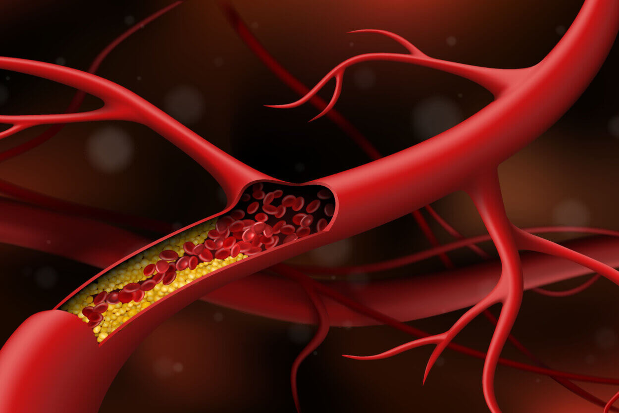 Von Cholesterin blockierte Arterie