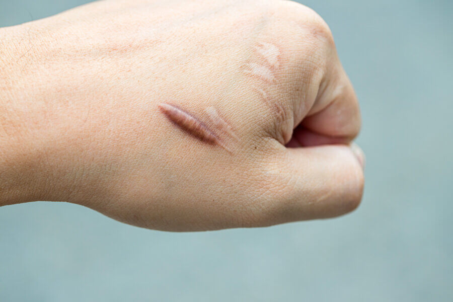 Keloide Narbe (Hypertrophische Scar) auf der Haut des Menschen nach einem Unfall.