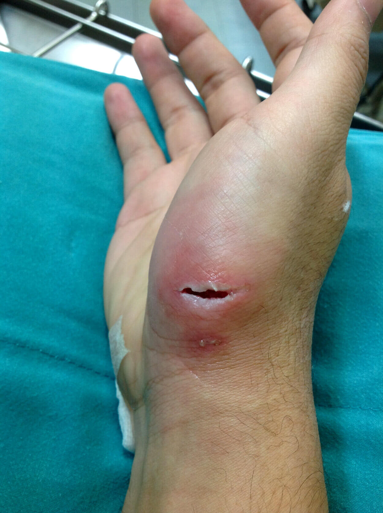 wundrand-das-sollten-sie-wissen-apotheken-welt