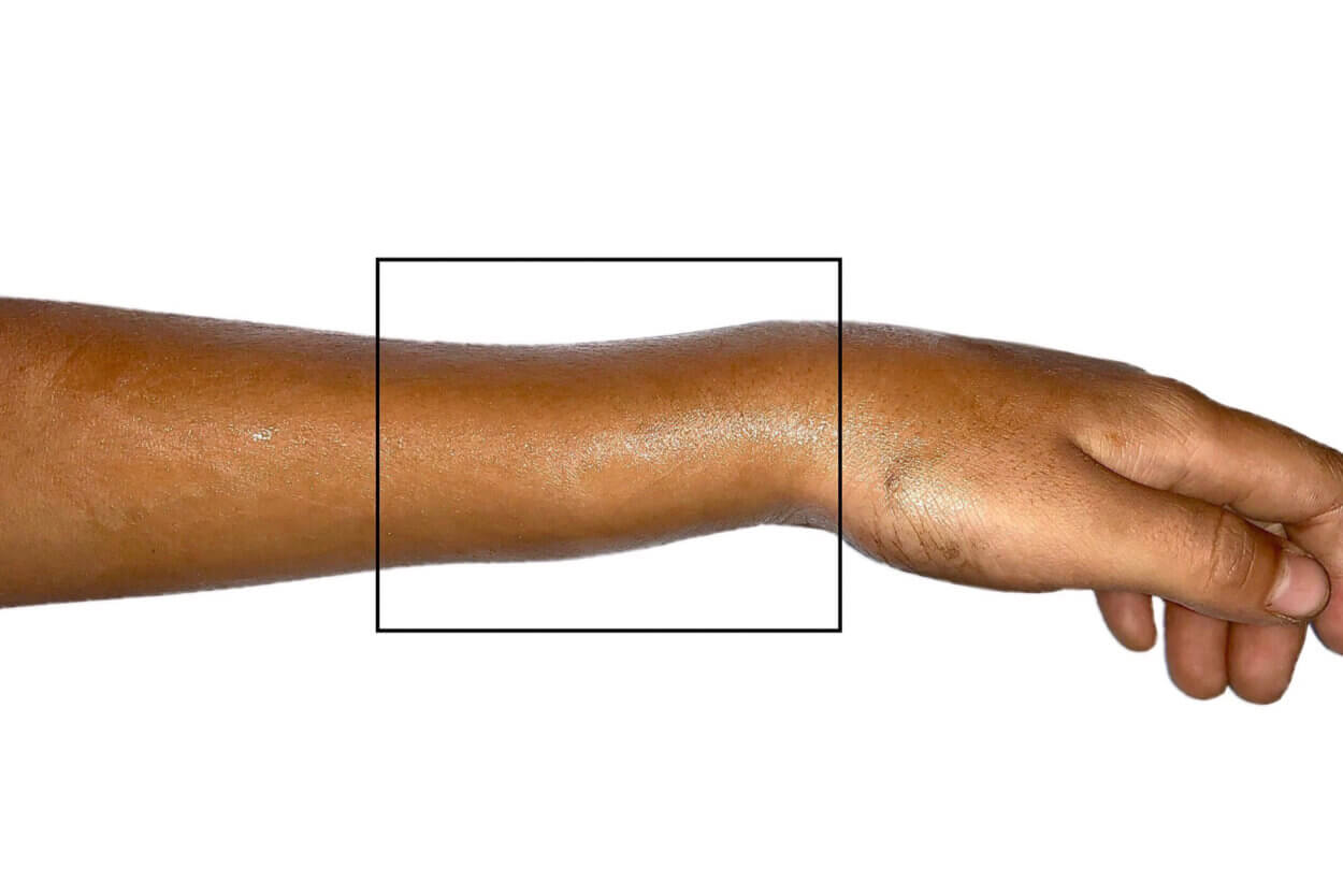 Sudeck mit geschwollener Hand