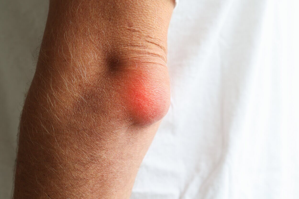 Ellenbogen von Olecranon Bursitis,