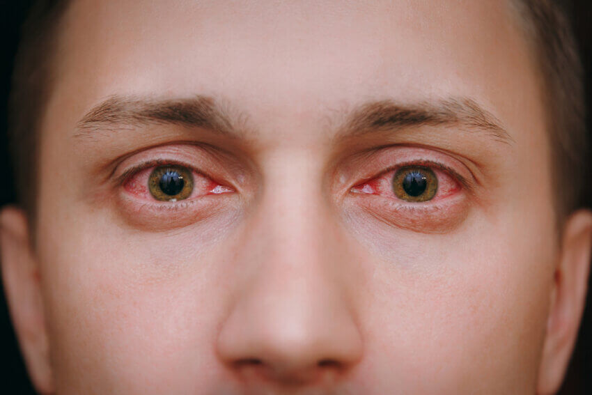 Bei Morbus Bechterew achten Sie auf Augenentzündungen 