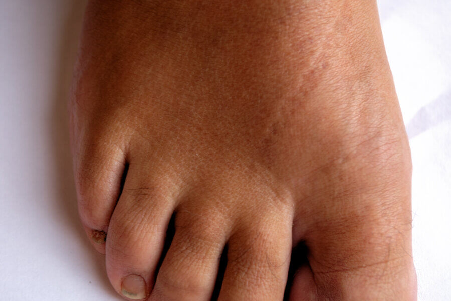 Hallux Rigidus