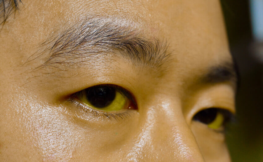 Gelbfärbung der Haut und der Augen kann auftreten