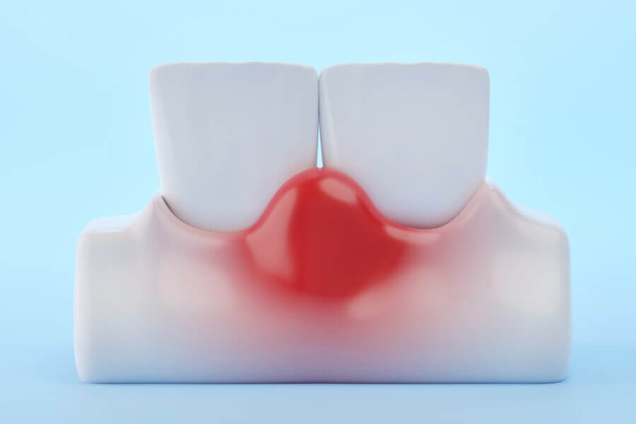 Gingivitis oder geschwollene Zahnfleischerkrankung mit den Vorderzähnen
