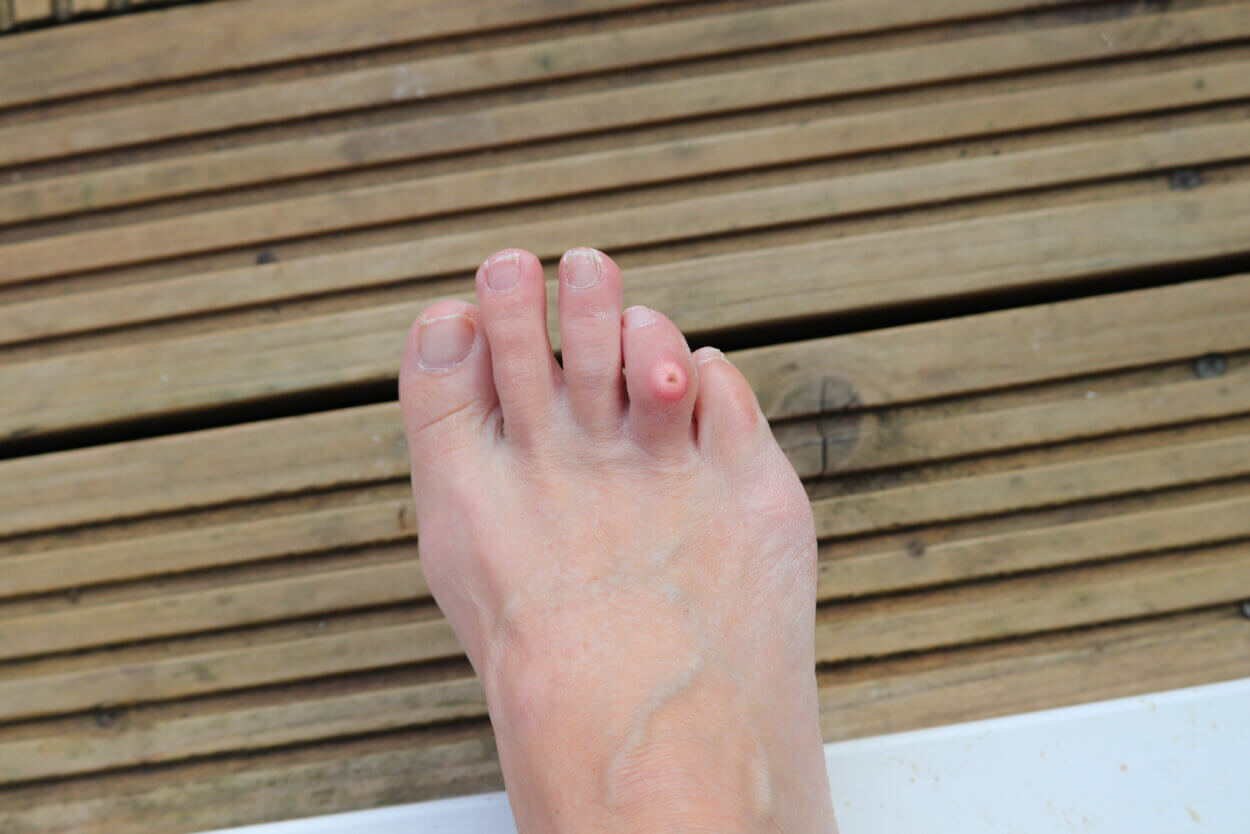 Typisches Hühnerauge auf dem Zeh durch Druck