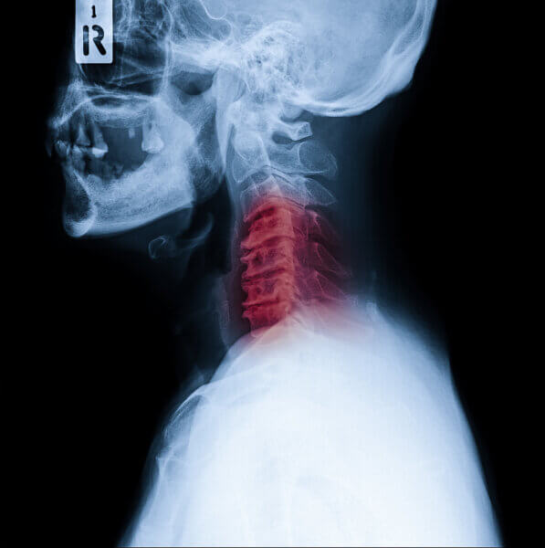 Röntgen bei neurologische Symptome 