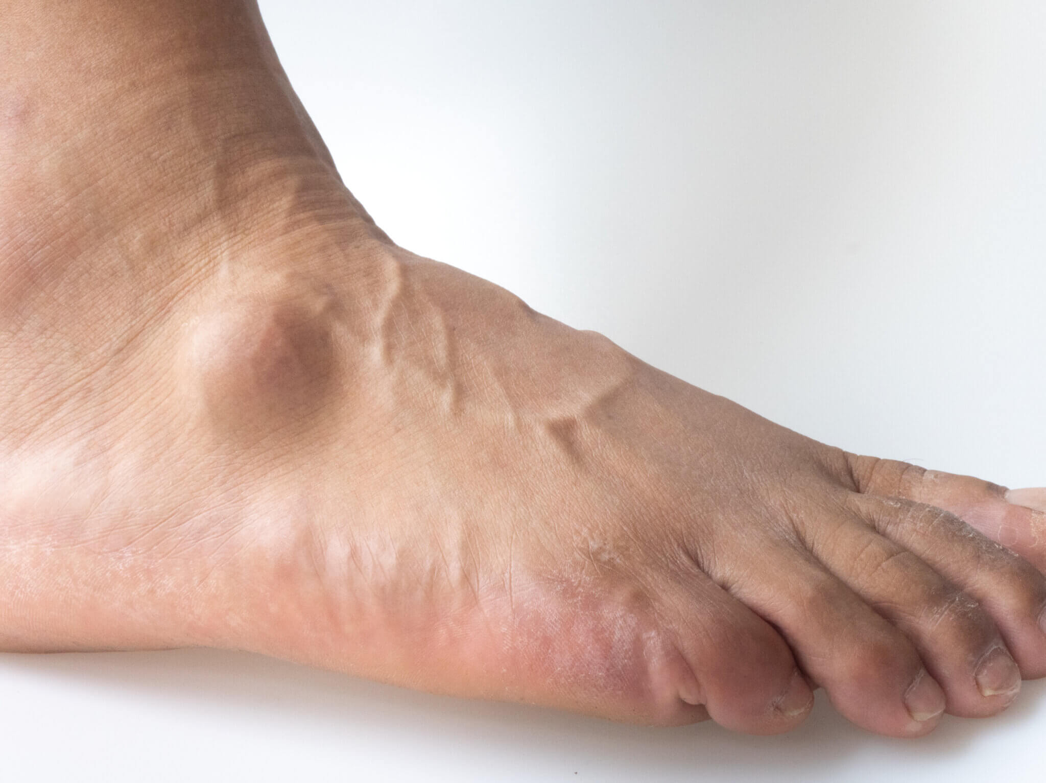 Was ist ein Ganglion? - Ursachen, Symptome und Behandlung - apotheken welt
