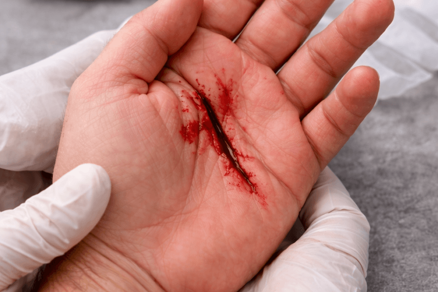 Schnittverletzung an der Hand